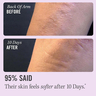 First Aid Beauty KP Bump Eraser Body Scrub with 10% AHA - Shopaholic